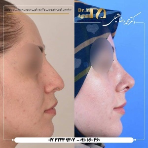 rhinoplasty-1
