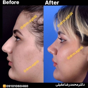 rhinoplasty-10-