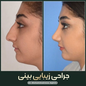 rhinoplasty-100