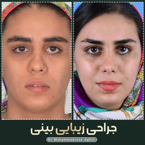 rhinoplasty-101