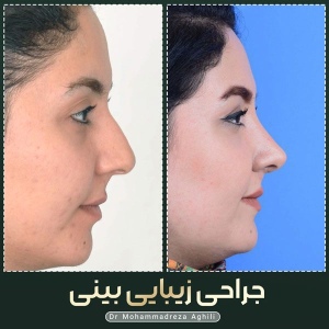 rhinoplasty-102