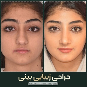 rhinoplasty-103
