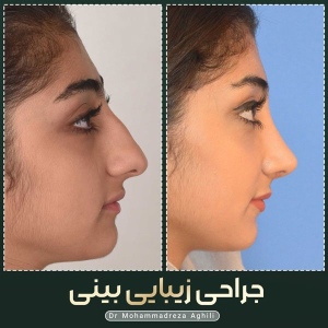 rhinoplasty-104