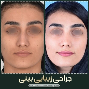 rhinoplasty-105