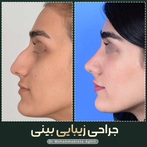rhinoplasty-106