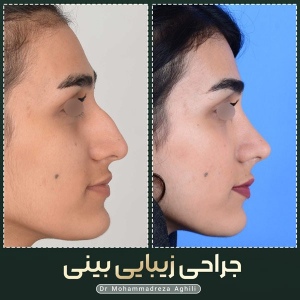 rhinoplasty-107
