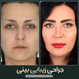 rhinoplasty-108