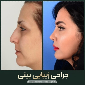 rhinoplasty-109