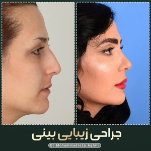 rhinoplasty-110