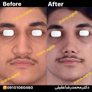 rhinoplasty-11jpg