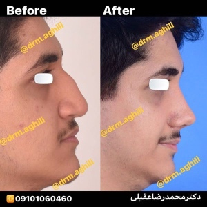 rhinoplasty-12-