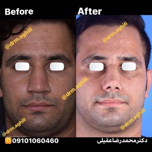 rhinoplasty-13
