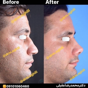 rhinoplasty-14