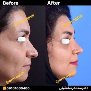 rhinoplasty-15