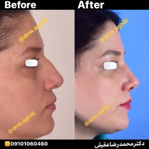 rhinoplasty-17