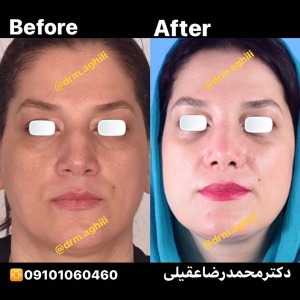 rhinoplasty-18