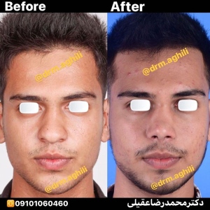 rhinoplasty-19
