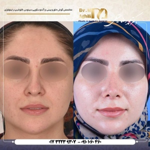 rhinoplasty-2