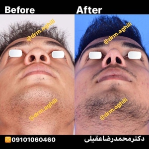 rhinoplasty-20