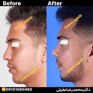 rhinoplasty-21