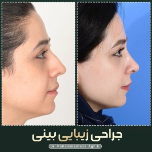 rhinoplasty-22