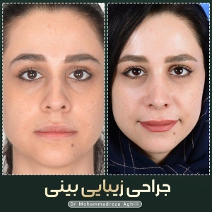 rhinoplasty-23