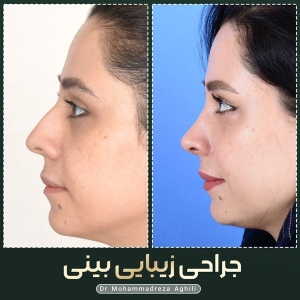 rhinoplasty-24