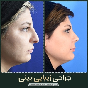 rhinoplasty-26