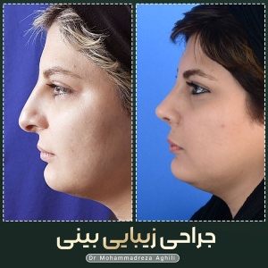 rhinoplasty-27