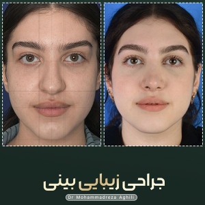rhinoplasty-28