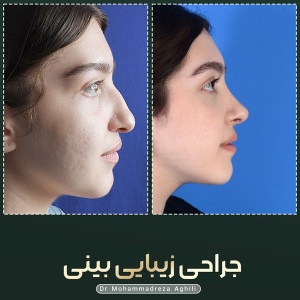 rhinoplasty-29