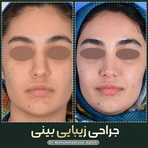 rhinoplasty-31