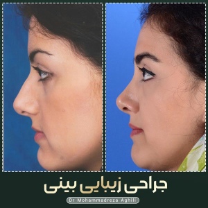 rhinoplasty-32