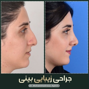rhinoplasty-33