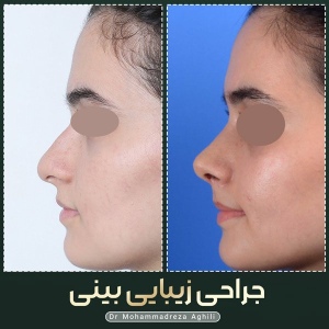 rhinoplasty-34