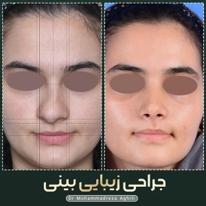 rhinoplasty-35
