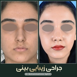 rhinoplasty-37