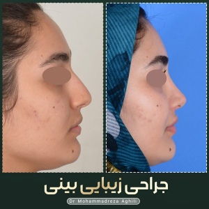 rhinoplasty-38