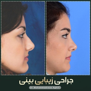 rhinoplasty-39