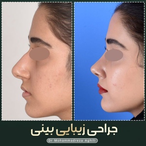 rhinoplasty-40