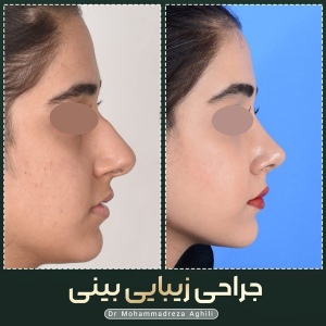 rhinoplasty-41