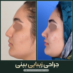 rhinoplasty-42