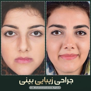 rhinoplasty-43