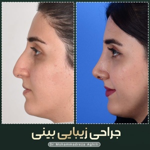 rhinoplasty-44