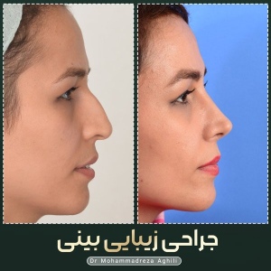 rhinoplasty-45