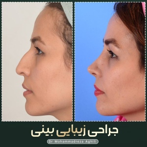 rhinoplasty-46