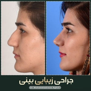rhinoplasty-47