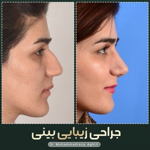 rhinoplasty-48