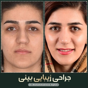 rhinoplasty-49