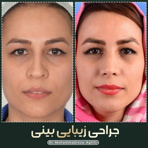 rhinoplasty-50